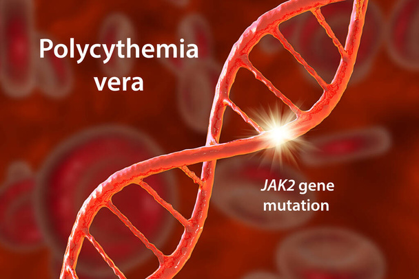 Polycythemia vera, een zeldzame langzaam groeiende bloedkanker met een toename van het aantal rode bloedcellen in het lichaam, 3D illustratie - Foto, afbeelding
