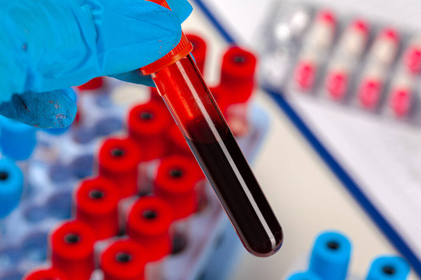 Blood test tube for analysis. 2019-nCoV virus infection originating in Wuhan, China - 写真・画像