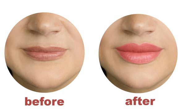 lábios menina antes e após a forma de aumento - Foto, Imagem