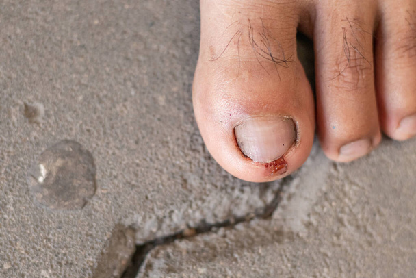 Le lesioni alle dita dei piedi sono causate dalla negligenza mentre camminano, causando le dita dei piedi a essere feriti e feriti perché inciampato su qualcosa sul pavimento. La ferita all'alluce ha causato dolore. - Foto, immagini