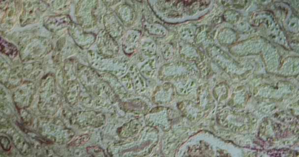 AIDS Candida w nerkach pod mikroskopem 100x - Materiał filmowy, wideo