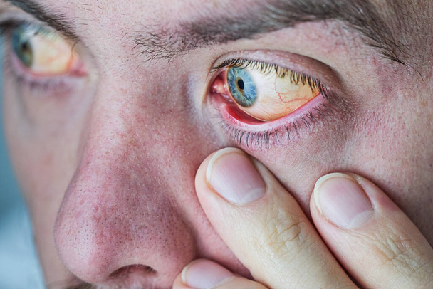 Ανθρώπινο μάτι με κίτρινο μάτι, κοντινό πλάνο. Τα κίτρινα μάτια είναι σύμπτωμα ηπατικής νόσου ή ηπατίτιδας - Φωτογραφία, εικόνα