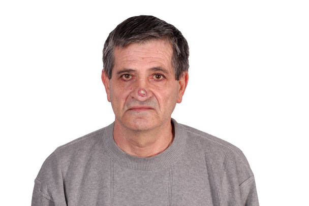 Retrato de un anciano adulto de pelo gris con una enorme herida podrida en la nariz aislada sobre fondo blanco. - Foto, Imagen