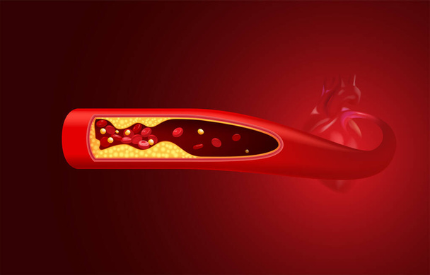 Los glóbulos rojos y el colesterol se obstruyen ante el corazón. - Vector, imagen