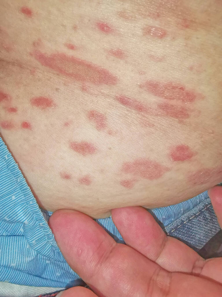PR Pityriasis rosea is a skin disease. It is assumed that it may be caused by a virus. which cannot be clearly proven - Photo, Image