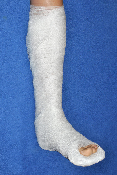 Σπασμένο πόδι - Φωτογραφία, εικόνα