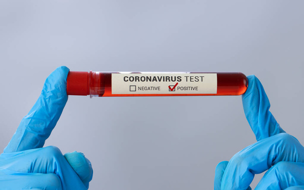 Doctor hand holding blood test tube positive with coronavirus - Foto, afbeelding