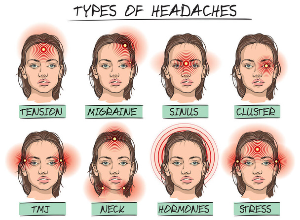 Illustration vectorielle de certains types de maux de tête et d'endroits sur la tête où la douleur pouvait être ressentie. - Vecteur, image