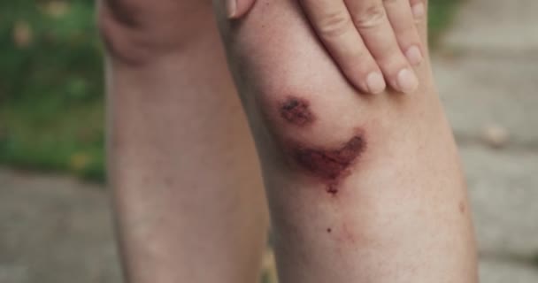Una donna tocca un ginocchio ferito con sangue secco. Lesioni durante la guida in bicicletta - Filmati, video
