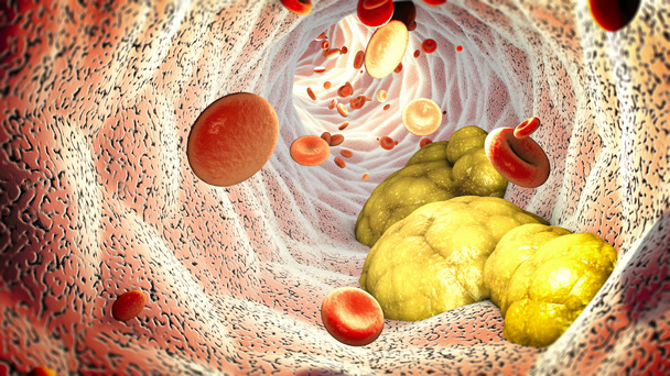Formación de colesterol, grasa, arteria, vena, corazón. Glóbulos rojos, flujo sanguíneo. Estrechamiento de una vena para la formación de grasa
 - Foto, imagen