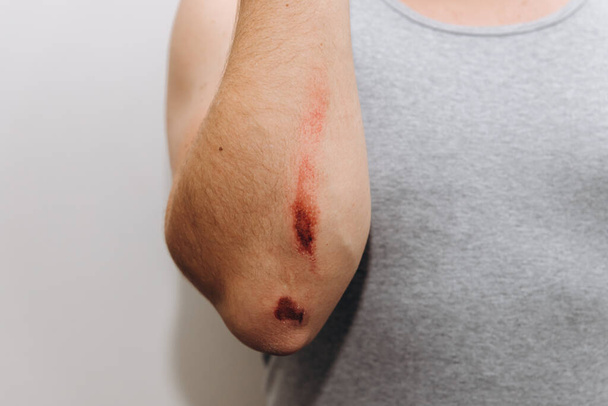 Grandes abrasiones en el antebrazo de un hombre después de una caída. - Foto, imagen