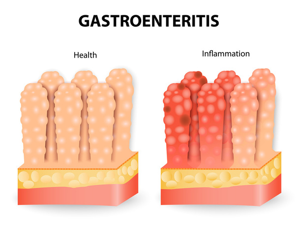 Gastroenteritis oder infektiöser Durchfall - Vektor, Bild