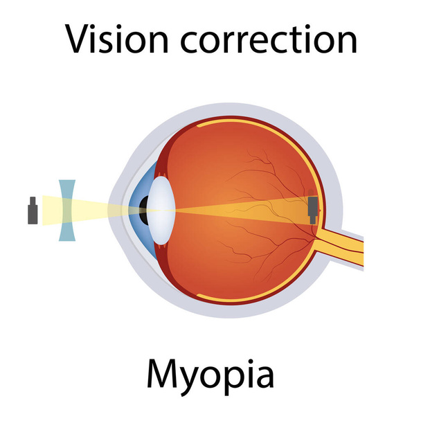 Visione Correzione della Miopia Illustrazione. Disturbi della vista. Difetto degli occhi corretto dal concetto di lente concava. Dettagliato bulbo oculare anatomico con difetto di miopia. Vettore isolato - Vettoriali, immagini