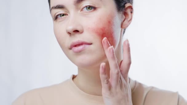 Close-up portrait of a young beautiful woman touching the redness on her cheek with her fingers. White background. The concept of rosacea and couperose. - Footage, Video