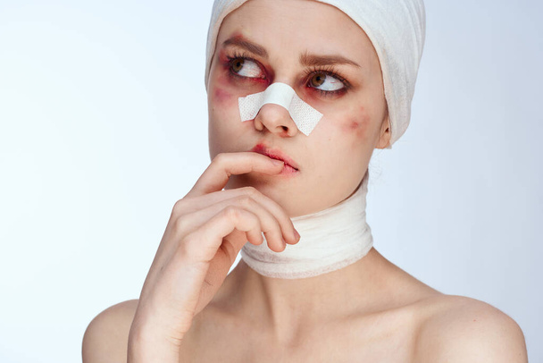 portrait of a woman bruised face medicine treatment injury accident close-up - Φωτογραφία, εικόνα