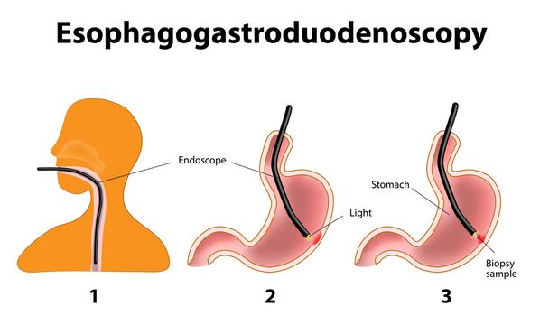 Esofagogastroduodenoscopia o esofagogastroduodenoscopia o pan
 - Vector, imagen