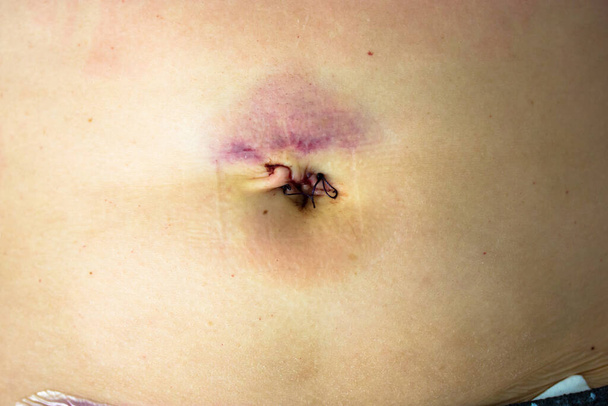 Woman's abdomen fresh medical scars after laparoscopy surgery, remove gallbladder, ovary, uterus, tumor. Wounds on woman's body, abdomen with band-aid. Belly button fresh stitches, hematoma, bruising. - Photo, Image