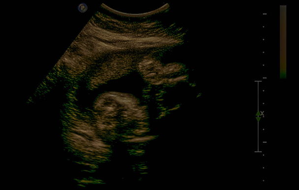 Υπερηχογράφημα του εμβρύου κατά τον τρίτο μήνα της εγκυμοσύνης. - Φωτογραφία, εικόνα