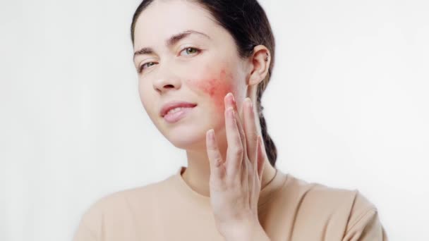 Portrait of a young beautiful woman touching her reddened cheek with her fingers. White background. The concept of rosacea. - Footage, Video