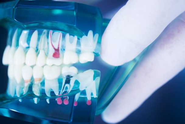 Οδοντιατρική αποσύνθεση υπόδειγμα που δείχνει τερηδόνα στα δόντια - Φωτογραφία, εικόνα