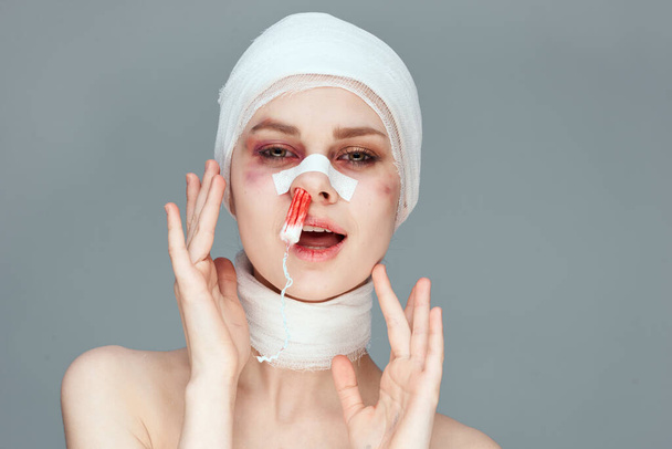 woman bruised face medicine treatment injury isolated background - 写真・画像