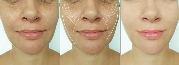 arrugas faciales de la mujer antes y después del tratamiento - Foto, Imagen