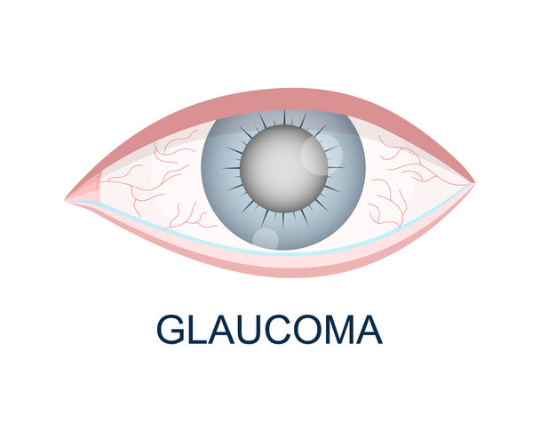 Oog met glaucoom van dichtbij gezien. Wazig, roodheid, waterige oogbal. Anatomisch nauwkeurig menselijk gezichtsorgaan. Oudere visuele problemen. Vectorillustratie - Vector, afbeelding