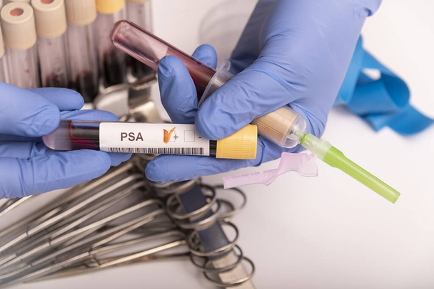 Blutprobe mit abnorm hohem PSA-Testergebnis. - Foto, Bild