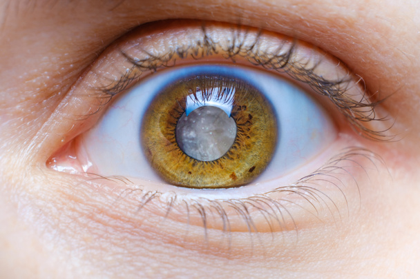 Menschliches Auge mit getrübter Linse, weißer Pupille, Katarakt-Makro - Foto, Bild