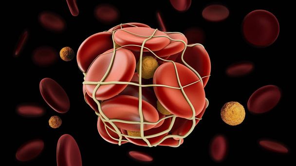 3D ilustrace hluboké žilní trombózy nebo krevních sraženin. Embolie, včetně střihové cesty - Fotografie, Obrázek