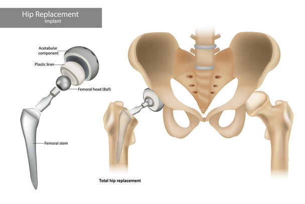 Componentes totales de reemplazo de cadera. Implante de cadera. - Vector, Imagen
