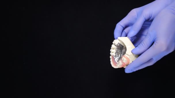 歯のブリッジとクラウンサンプルと青手袋保持顎モデルの女性の手。黒の背景。歯の概念。縦の映像。歯科でのヒト歯のデモンストレーションモデル。歯 - 映像、動画