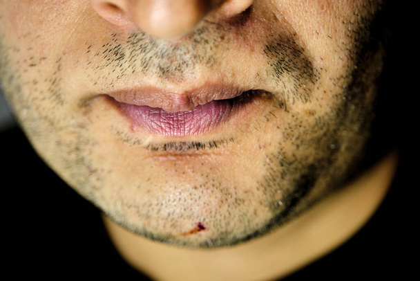 Face of a man, mount and injury and hurt in his chin and lack of beard. - Foto, immagini