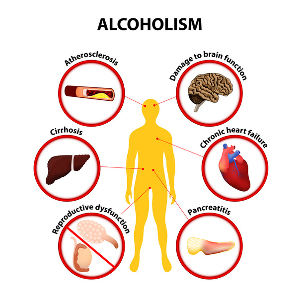 alcoholisme. Infographic - Vector, afbeelding