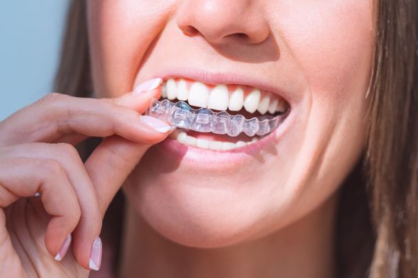 Kusursuz gülüşlü bir kadın diş düzeltmesi için görünmez diş düzenleyicileri takıyor. - Fotoğraf, Görsel