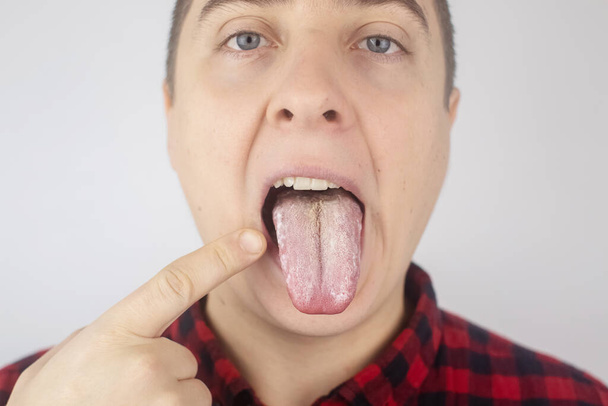 Valkoista juustoa kielessä. Lääkäri tai gastroenterologi tutkii miehen kieltä. Potilaalla on huono suuhygienia tai sairauden oire. Piilevän sairauden oireet. - Valokuva, kuva