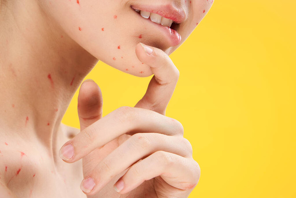 female face closeup red dots dermatology rash - Foto, Bild