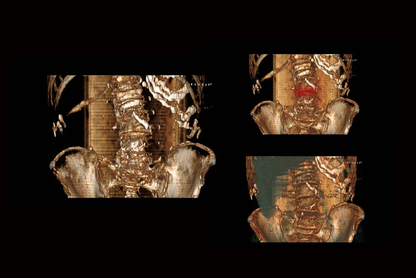 υπολογιστική τομογραφία της σπονδυλικής στήλης με κάταγμα των σπονδύλων και την μετατόπισή τους από ένα άτομο του ορογόνου, κάταγμα των σπονδύλων με συστολή και οστεοχάνρωση - Φωτογραφία, εικόνα