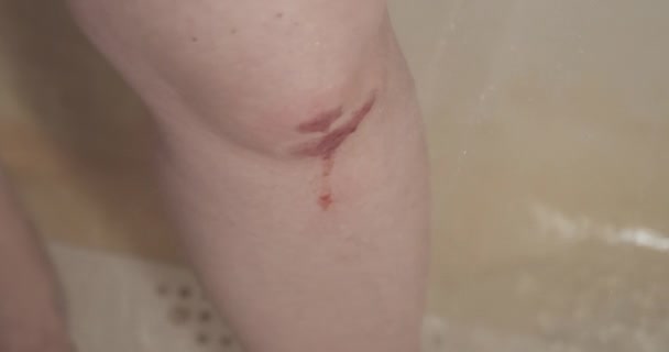Женщина моет и дезинфицирует раненое колено - Кадры, видео