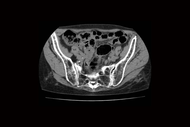 tomografia computerizzata della colonna vertebrale con frattura delle vertebre e loro spostamento da una persona taorogo, frattura delle vertebre con contrazione - Foto, immagini