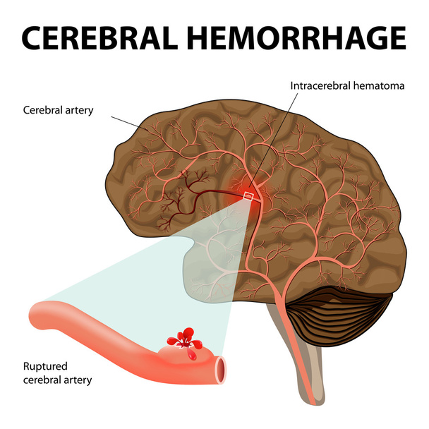 Cerebral hemorrhage - Vector, Image