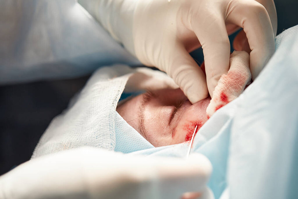 Close-up van het gezicht van een patiënt die blefaroplastiek ondergaat. De chirurg snijdt het ooglid door en voert manipulaties uit met behulp van medische instrumenten - Foto, afbeelding