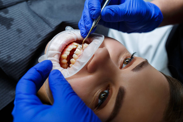 Ортодонт накладывает металлические брекеты на зубы пациента. Ортодонтическое лечение зубов. Высокое качество фото - Фото, изображение
