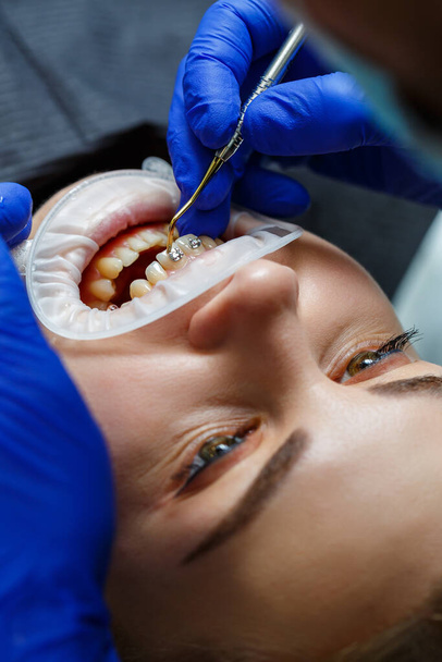 A fogorvos fémfogszabályzót tesz a beteg fogaira. Fogászati fogászati kezelés. Kiváló minőségű fénykép - Fotó, kép