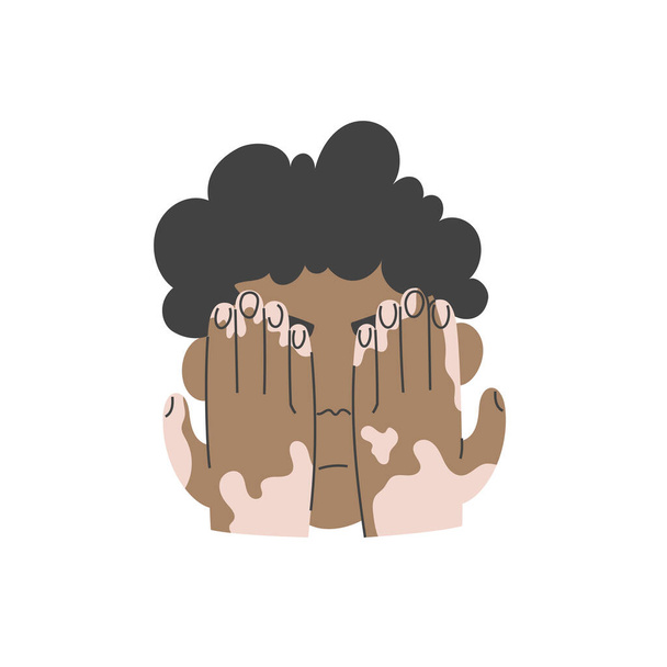 Der Mann mit Vitiligo versteckt sich verschämt hinter seinen Händen - Vektor, Bild