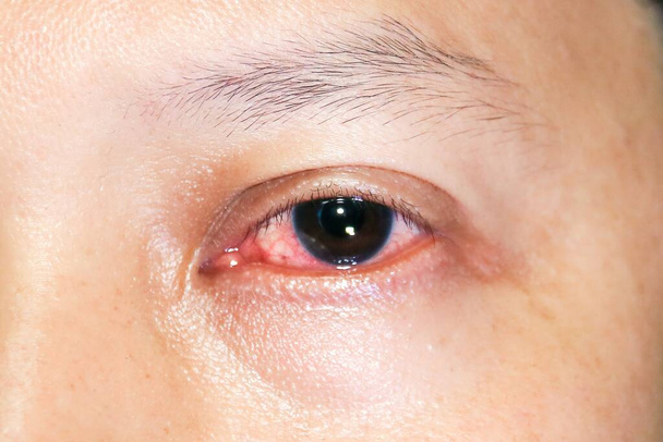 Auge aus nächster Nähe hat Infektion und Bindehautentzündung - Foto, Bild