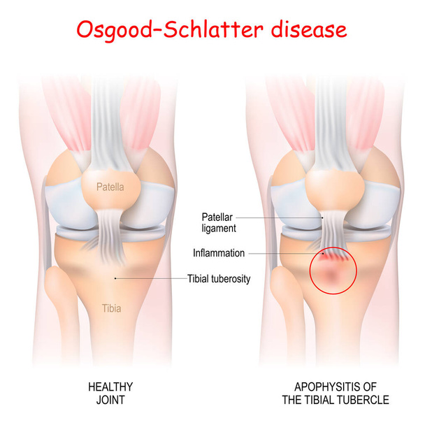 Osgood-Schlatter hastalığı. Tibial tüberkülde sağlıklı eklem ve apofizit. Vektör çizimi. Tıbbi kullanım için poster - Vektör, Görsel