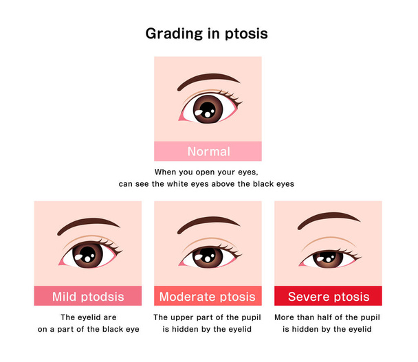 Grading in ptosis vector illustration - Vector, Image