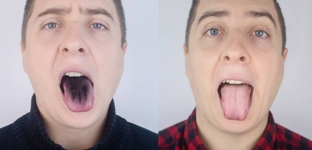 Antes e depois. Close-up de um homem língua negra. Manifestações clínicas da língua villosa. Infecção bacteriana da boca. As consequências de tomar antibióticos fortes. Infecção fúngica - Foto, Imagem