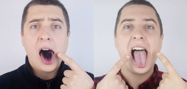 До и после. Крупный план человека с черным языком. Клинические проявления lingua villosa. Бактериальная инфекция рта. Последствия приема сильных антибиотиков. Грибковая инфекция - Фото, изображение